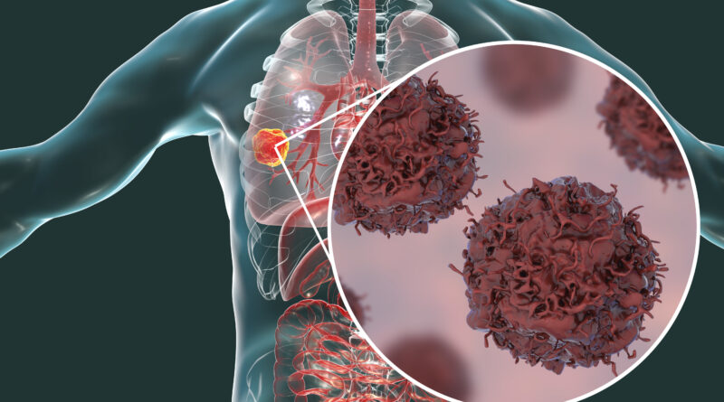 Dual immunotherapy plus chemotherapy helps patients with lung cancer